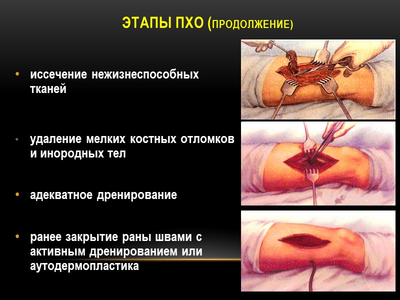 Этапы Пхо (продолжение) иссечение нежизнеспособных тканей     удаление мелких костных отломков